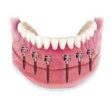 Snap On Mini-Implants